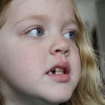 losttooth